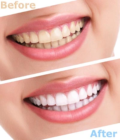 before and after teeth whitening services at Stein Dental Care
